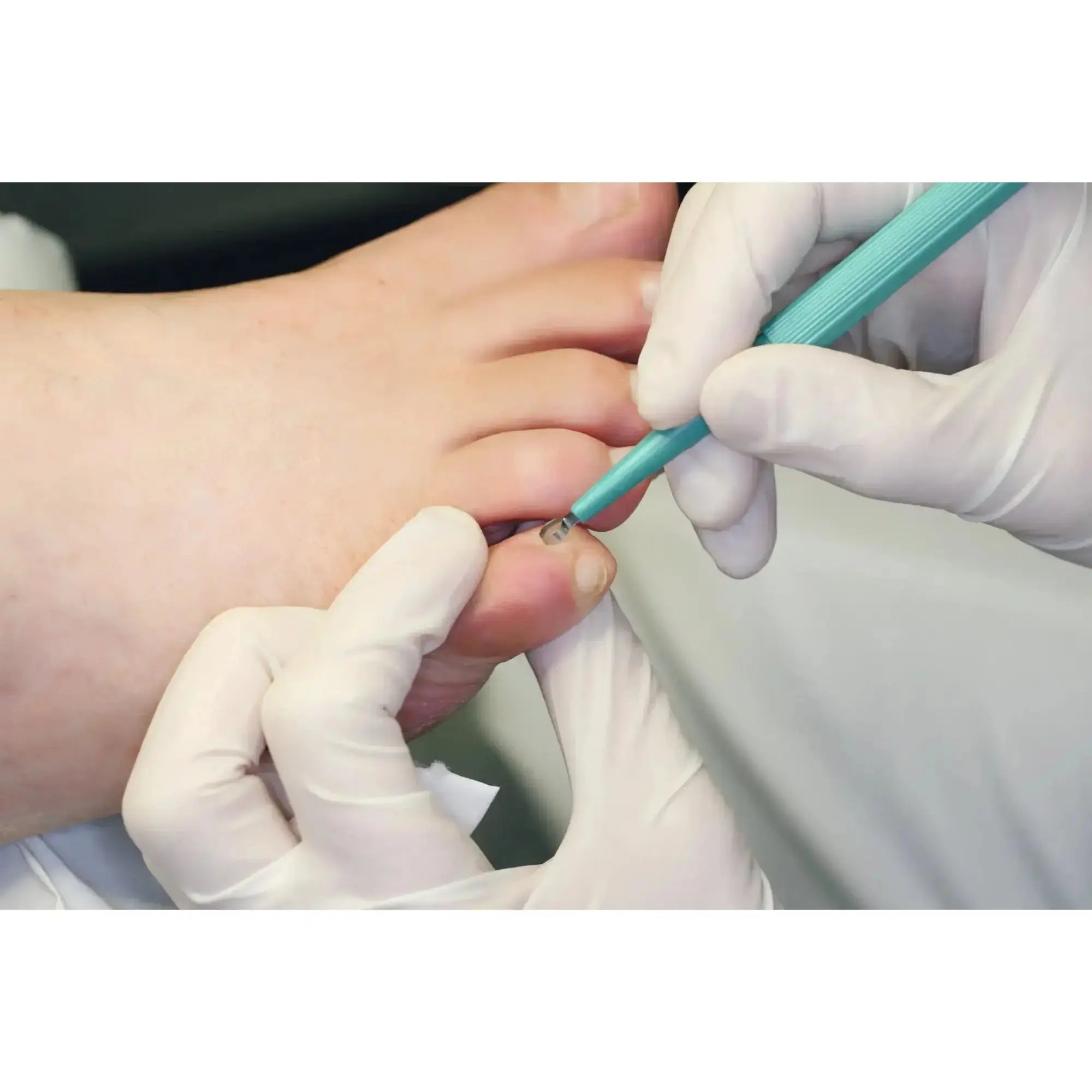 Skin curette - Length: 15 cm - Ruck Ruck 